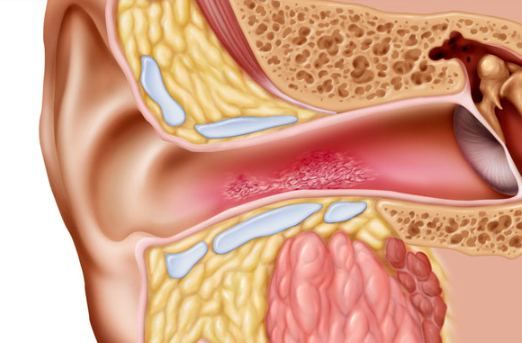Ear anatomy illustration showing an inflamed outer ear canal | Swimmers Ear Treatment in Levent | Online Doctor & Online Prescription | E-rx.online